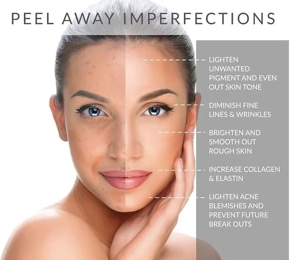 Chempeel peel away imperfections