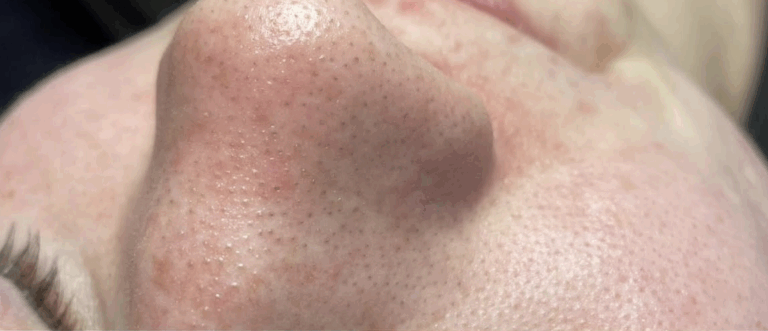 Before Image: Hydrafacial - front