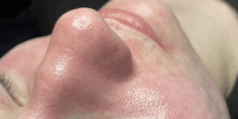 After Image: Hydrafacial - front
