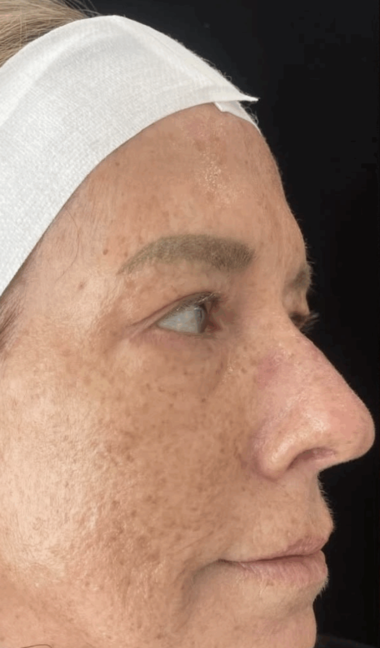 Before Image: IPL - right-side