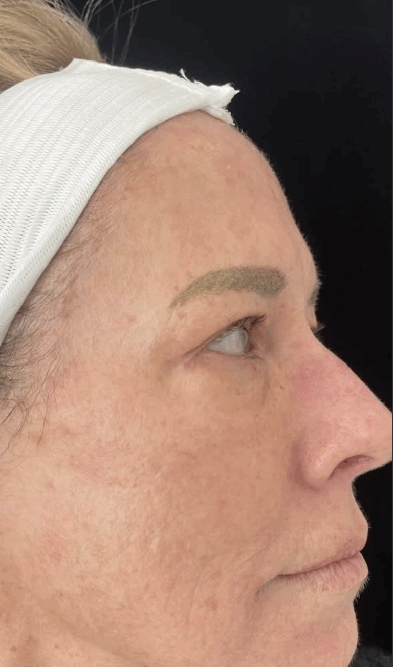 After Image: IPL - right-side