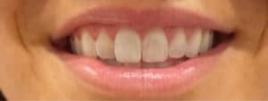 Before Image: Lip Flip (Botox)