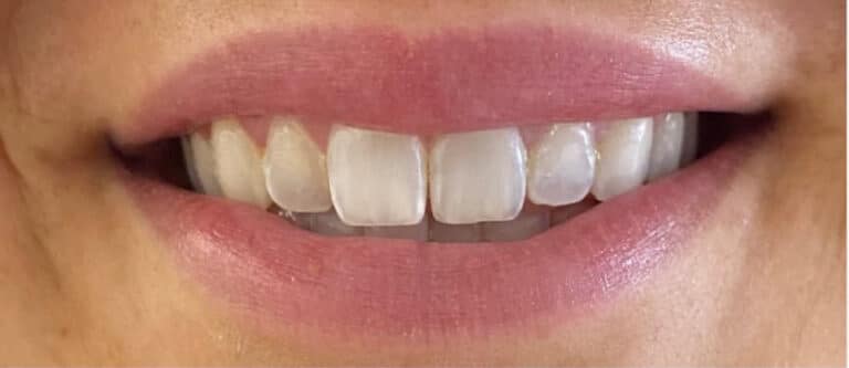 After Image: Lip Flip (Botox) - front