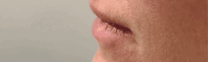 Before Image: Lip Filler