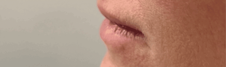 Before Image: Lip Filler - left-side
