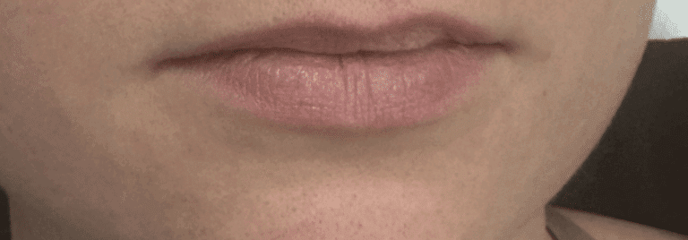 Before Image: Lip Filler - front