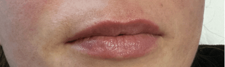 After Image: Lip Filler - front