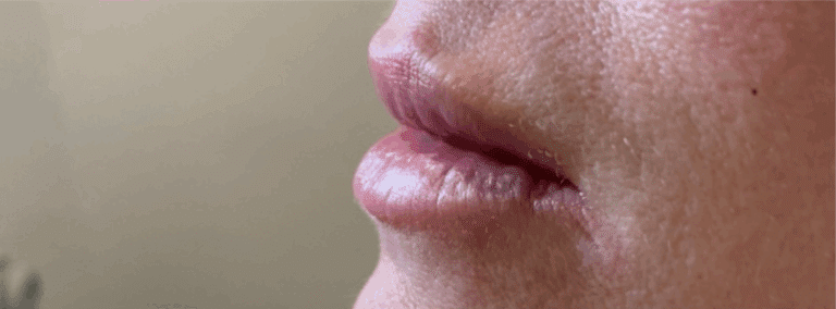After Image: Lip Filler - left-side
