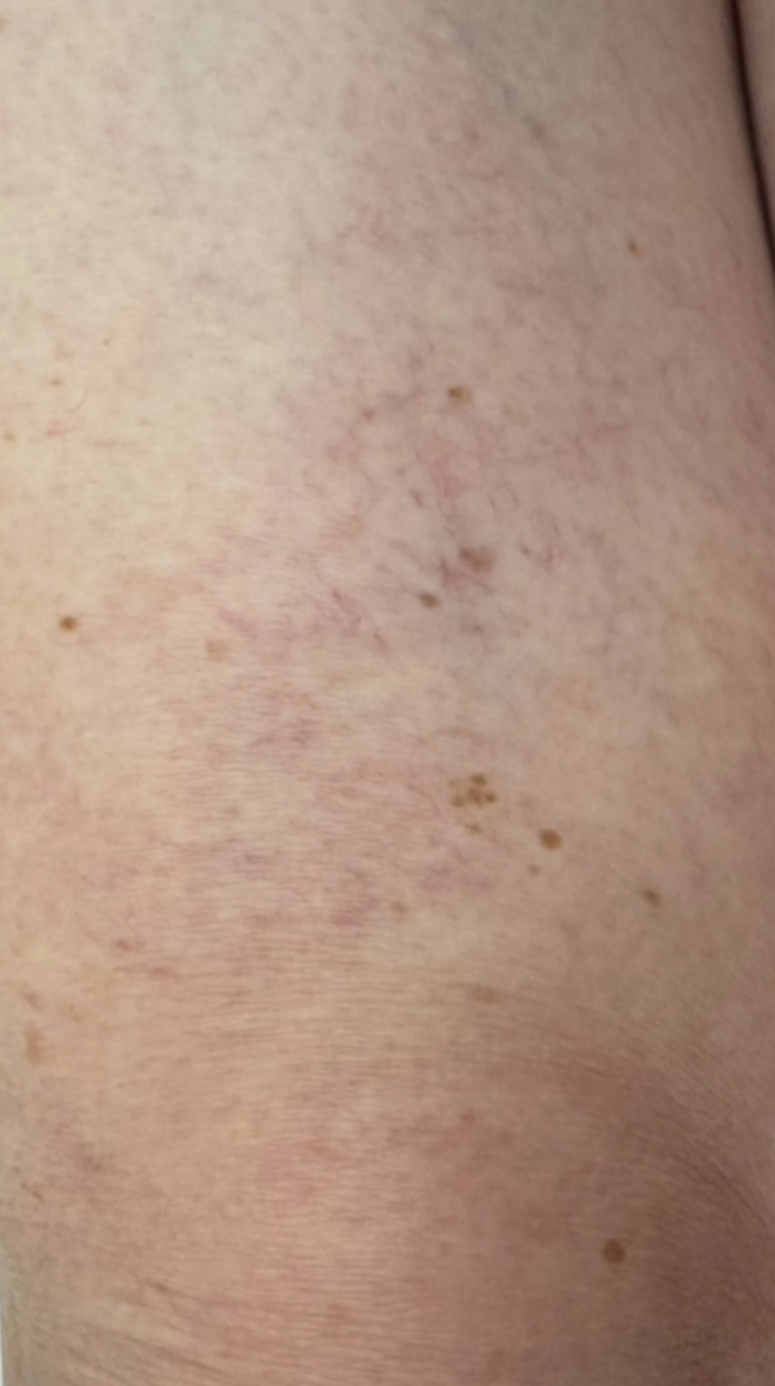 After Image: Sclerotherapy - front