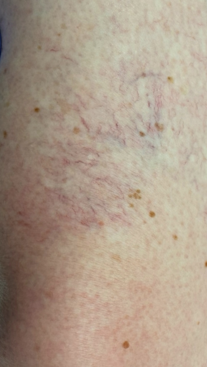 Before Image: Sclerotherapy - front