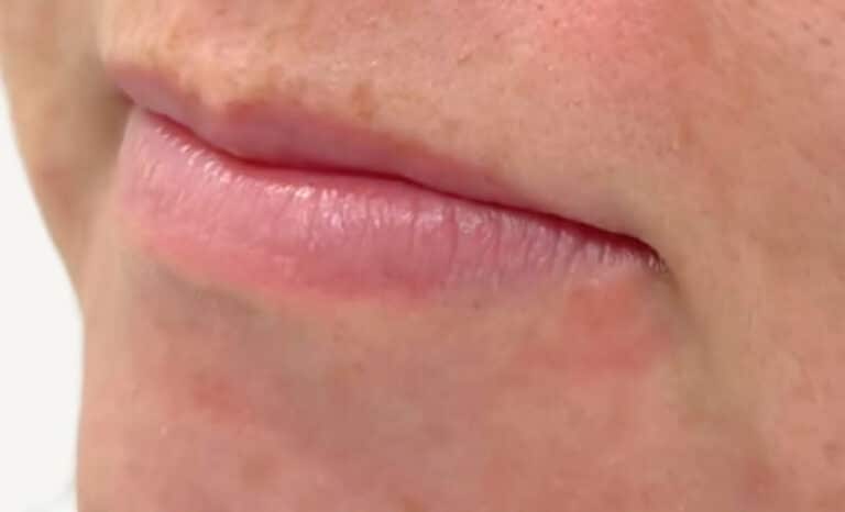 Before Image: Lip Filler - front