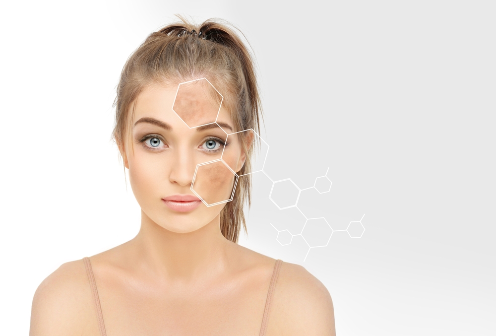 Close-up of skin with dark spots, freckles, and hyperpigmentation treated with AHA chemical peel for skin brightening and lightening.