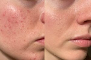 Close-up of woman’s oily, acne-prone skin texture before hydro facial treatment for deep cleansing and rejuvenation